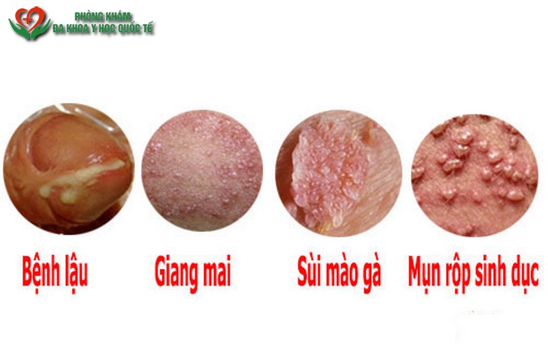 bệnh xã hội thường gặp
