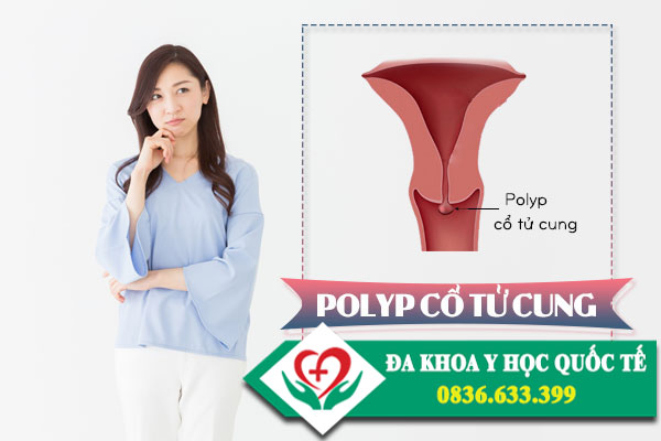 Bệnh polyp cổ tử cung là gì? Địa chỉ chữa trị bệnh polyp cổ tử cung ở hà nội