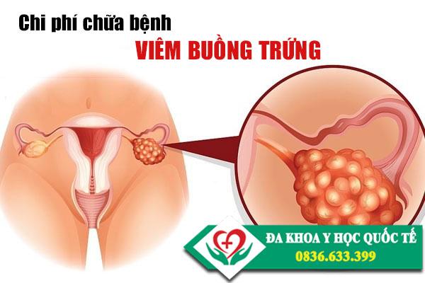 Chi phí chữa trị bệnh viêm buồng trứng ở Hà Nội