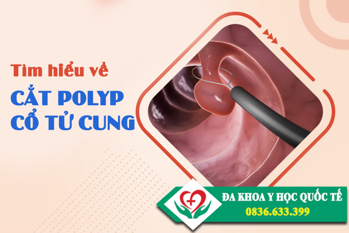 Tìm hiểu về cắt polyp cổ tử cung, cắt polyp cổ tử cung có đau không?