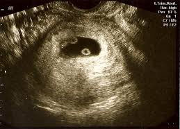 Hình ảnh siêu âm thai đôi 6 tuần tuổi