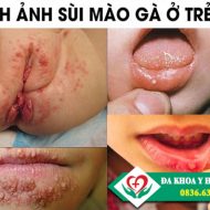 hinh-anh-sui-mao-ga-o-tre-em